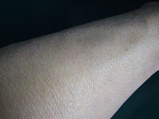 図1:完治した左腕 <push>→図2:左腕の炎症 <click>→図3:ほぼ完治の右腕と対処薬群