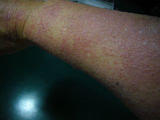 図1:腕にも <click>→図2:顔全体にも