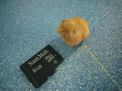 図1:抜いて貰った綺麗な大臼歯 <click>→図2:幾つものクスリ